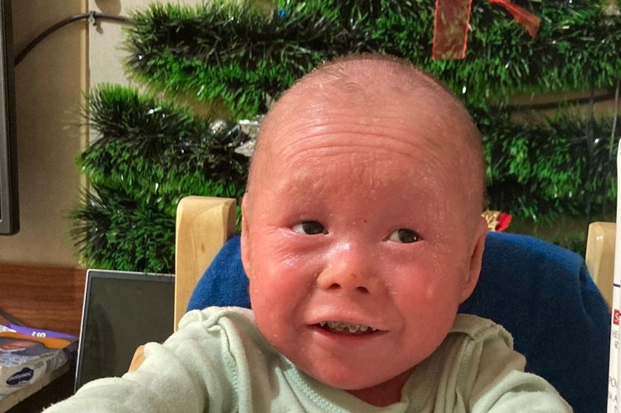 Ayudemos a Noah a cuidar su piel